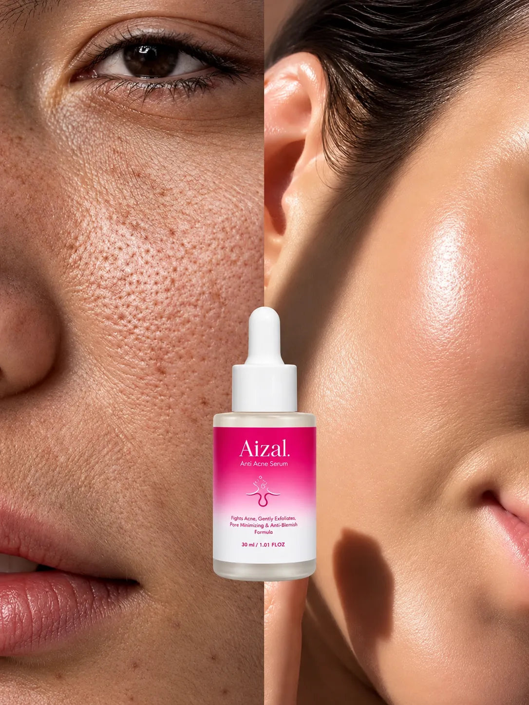 Aizal Anti Acne Serum designed for acne prone skin.